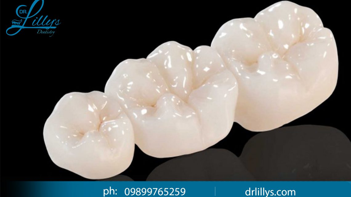 Metal free dentistry in vasant kunj