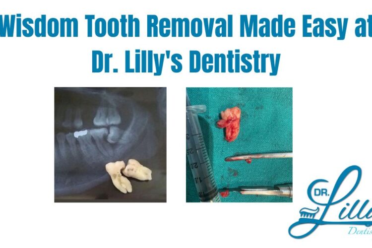 Wisdom Tooth Removal Made Easy at Dr. Lilly's Dentistry