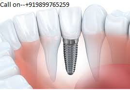 Implant dentist in vasant kunj