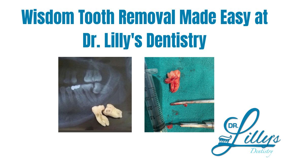Wisdom Tooth Removal Made Easy at Dr. Lilly's Dentistry